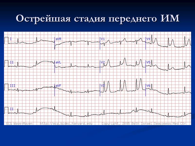 Острейшая стадия переднего ИМ